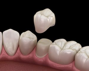 Dental crowns dr sheida clinic