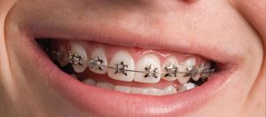 ارتودنسی دندان پزشکی