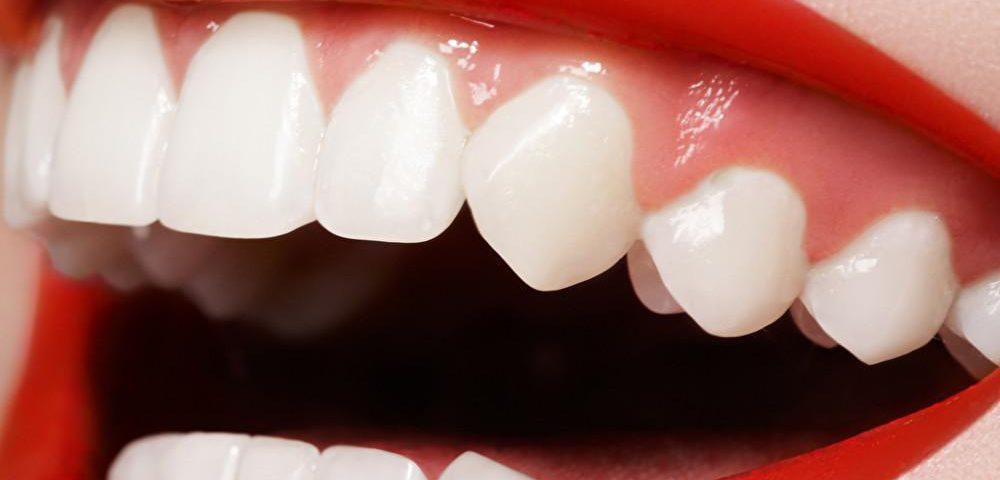 بلیچینگ دندان و سفید کردن دندان