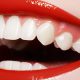 بلیچینگ دندان و سفید کردن دندان
