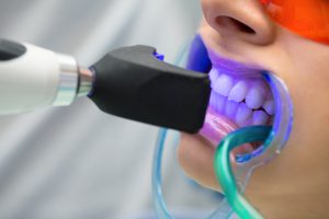 بلیچینگ دندان/کلینیک دندانپزشکی