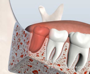 جراحی دندان عقل دندان پزشکی