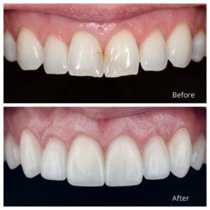 روکش دندان در دندانپزشکی چیست؟