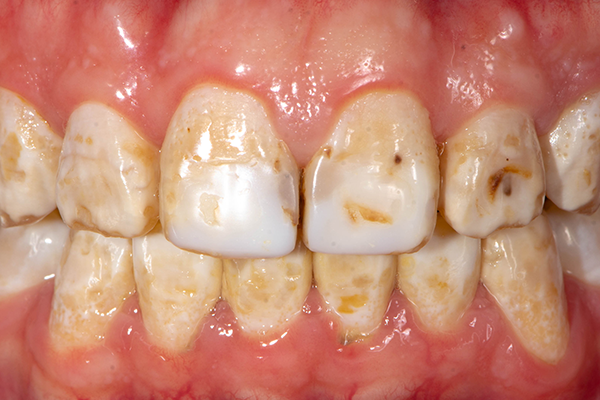 فلوئوروزیس دندان چیست؟ راه درمان فلوئوروزیس دندان چیست؟