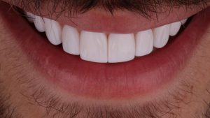 دندانپزشکی نیاوران | کامپوزیت ونیر چیست؟