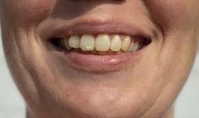 فلوئوروزیس دندان چیست؟-کلینیک دندانپزشکی