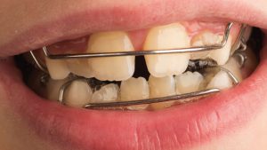 سن ارتودنسی دندان پزشکی