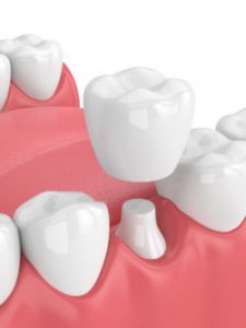 عوارض کامپوزیت دندان چیست