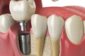 مراقبت از ایمپلنت دندان | قبل و بعد از جراحی