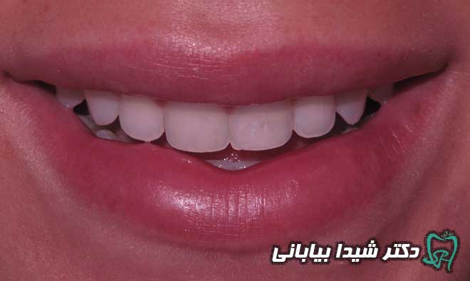 ونیر کامپوزیت دندان