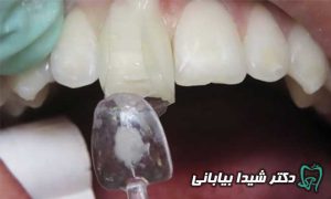 معایب ونیر کامپوزیت دندان