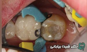 کامپوزیت ونیر دندان پزشکی