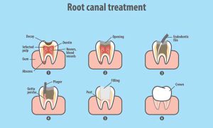 مراحل درمان کانال ریشه دندان