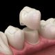 پرسلن دندان چیست؟