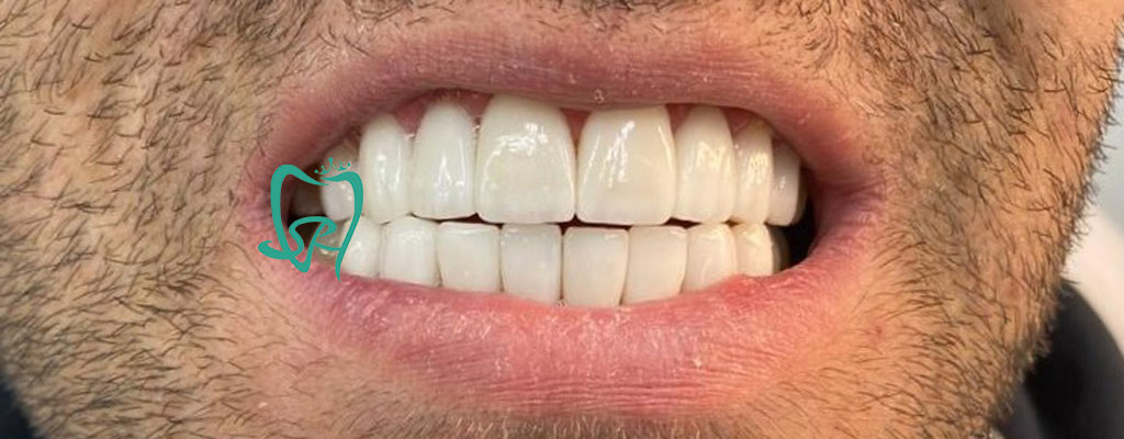 کامپوزیت دندان و موارد استفاده