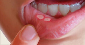 درمان گیاهی آفت دهان
