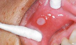 درمان گیاهی آفت دهان