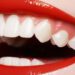 بلیچینگ و سفید کردن دندان چیست؟ معایب و مزایا !