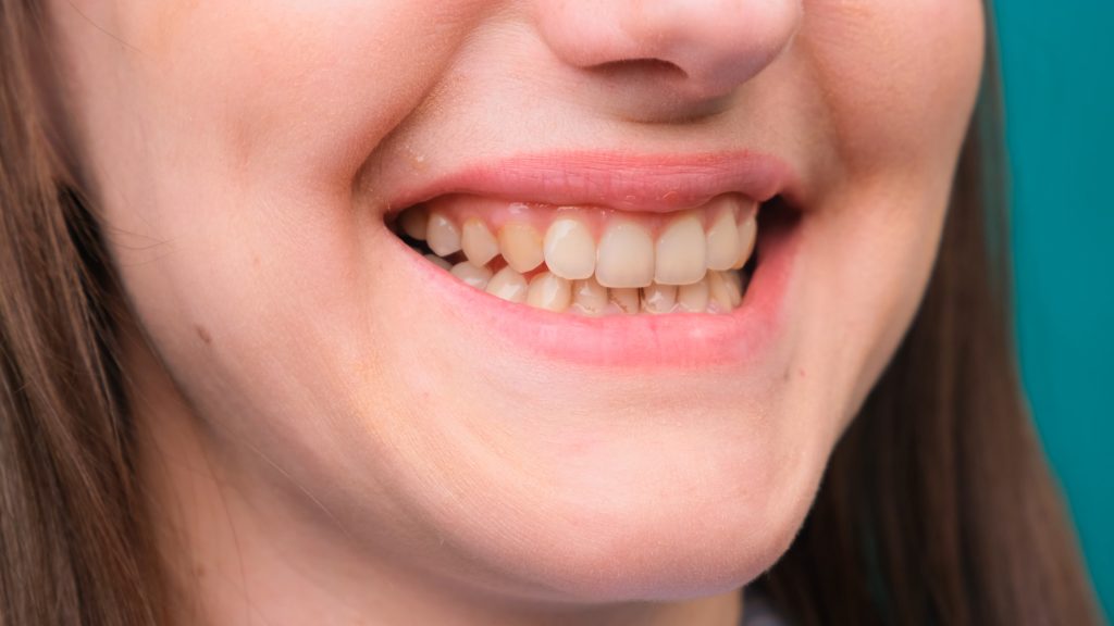 فلوئوروزیس دندان چیست؟ روش درمان و مضرات آن بر سلامتی انسان