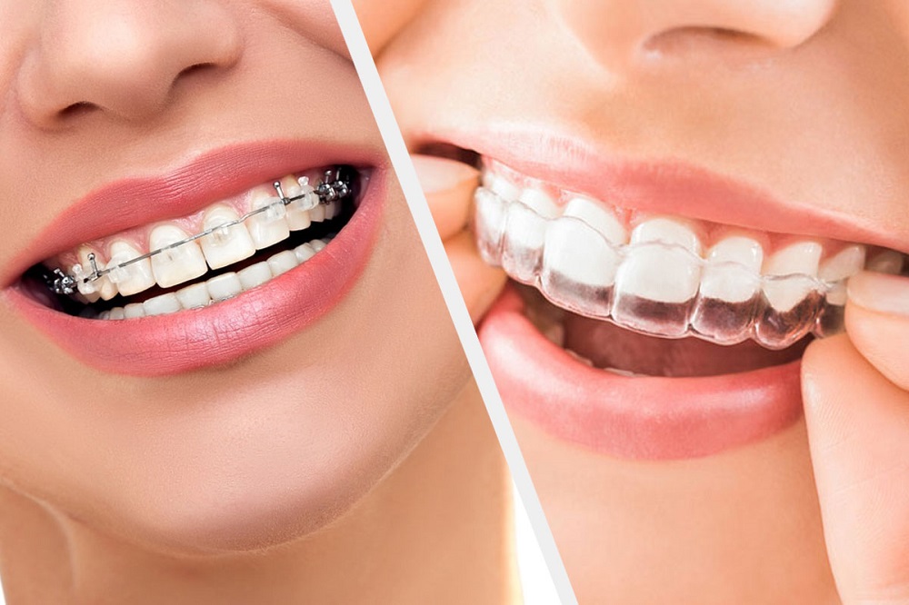 5 نوع بریس ارتودنسی دندان