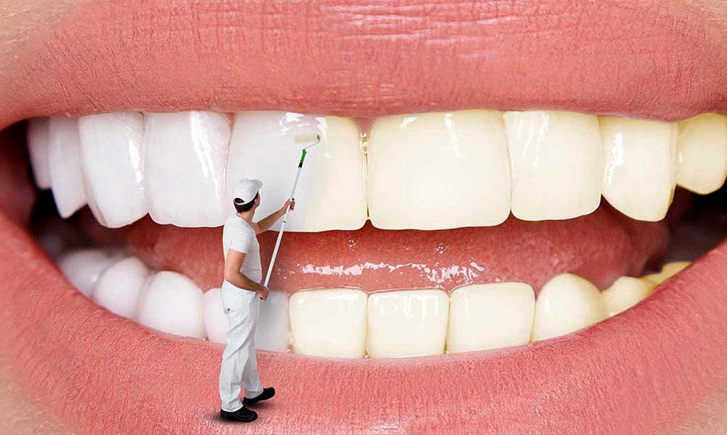 ضرر بلیچینگ برای دندان چیست؟ مزایای سفید شدن دندان چیست؟