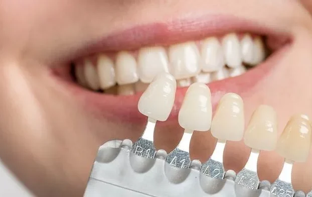 3 نوع لمینت دندان