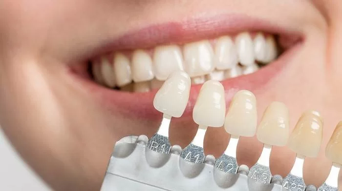 3 نوع لمینت دندان
