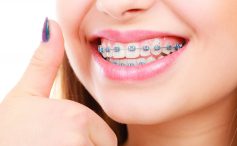 قیمت ارتودنسی دندان ۱۴۰۰ و عوامل موثر بر آن