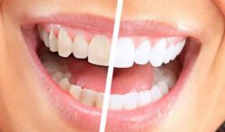 لمینت سرامیکی دندان چیست؟ و چه کاربردی دارد!