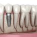 مراقبت از ایمپلنت دندان