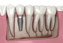 مراقبت از ایمپلنت دندان | قبل و بعد از جراحی