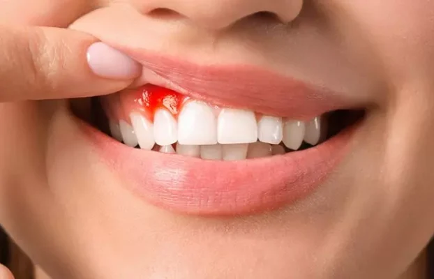 عفونت لثه را بشناسیم! چه دلایلی سبب عفونت در دهان می شود؟