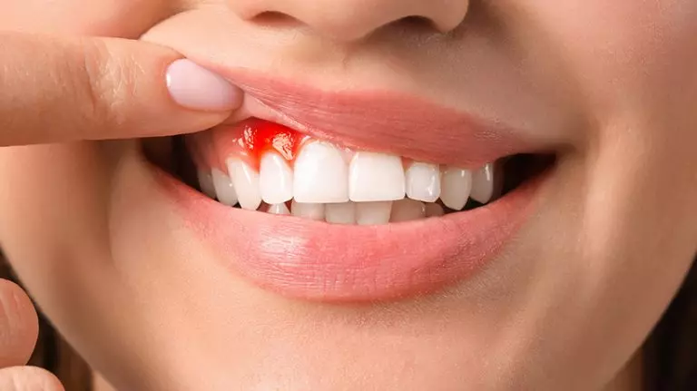 عفونت لثه را بشناسیم! چه دلایلی سبب عفونت در دهان می شود؟