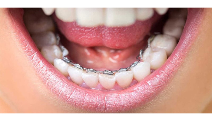 مراحل ارتودنسی ثابت و یا پشت دندانی