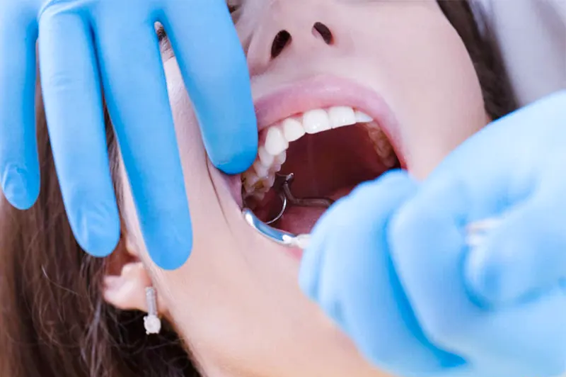 دندان عقل چیست