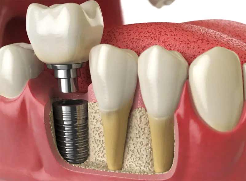 ایمپلنت دندان | انواع + قیمت