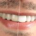جلوگیری پوسیدگی دندان