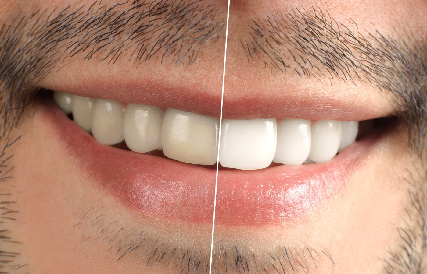 جلوگیری از پوسیدگی دندان