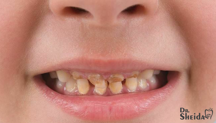 علل زردی دندان در کودکان
