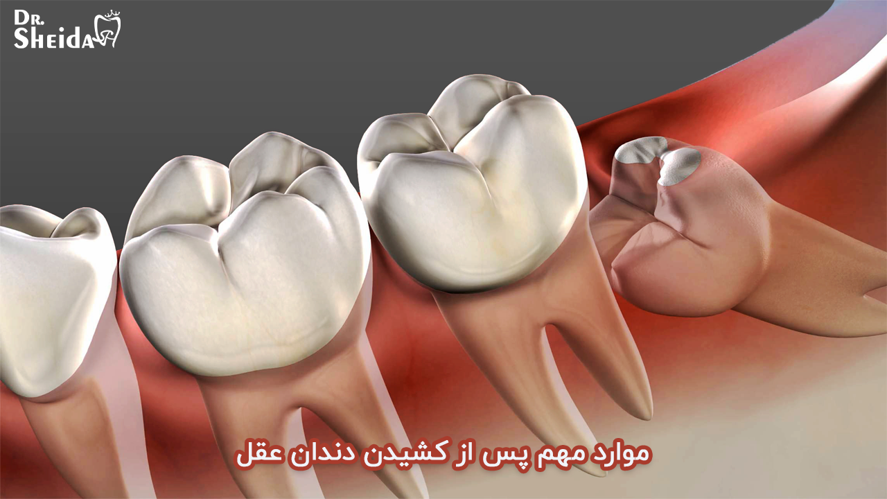 موارد مهم پس از کشیدن دندان عقل