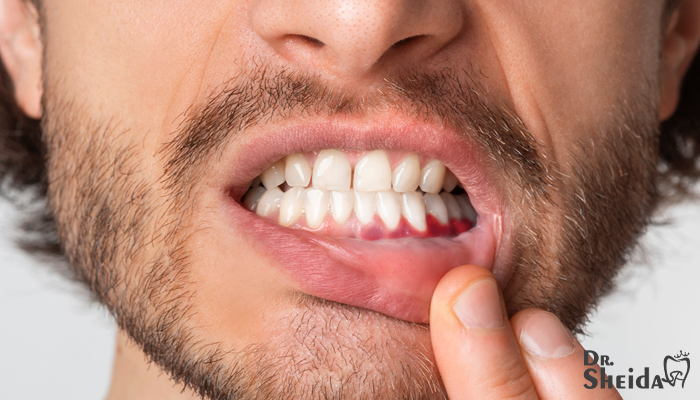 تسکین التهاب لثه بعد از جراحی دندان
