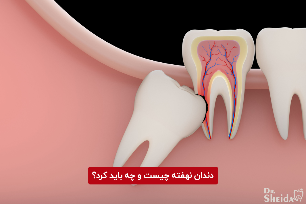 دندان نهفته چیست و چه باید کرد؟