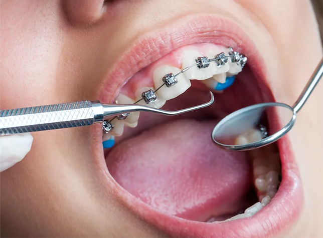 ارتودنسی دندان در چه زمانی مناسب است؟
