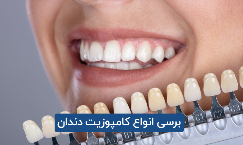 کامپوزیت دندان و برسی انواع مختلف آن