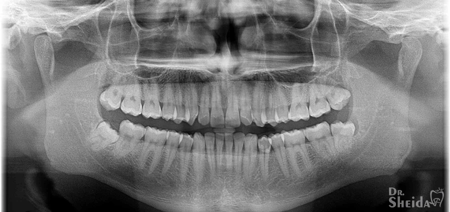عکس OPG در دندان پزشکی و نگرانی از اشعه ایکس ری