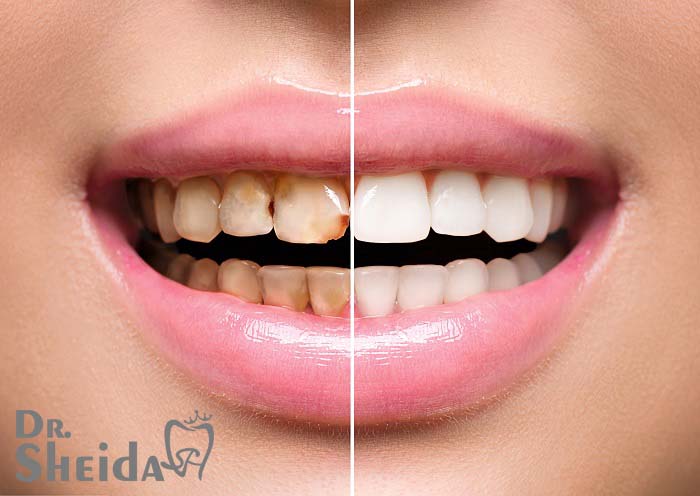 قبل و بعد لمینت دندان