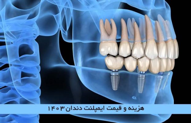 هزینه و قیمت ایمپلنت دندان 1403