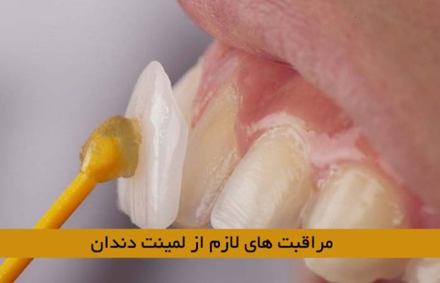 مراقبت ‌های لمینت دندان
