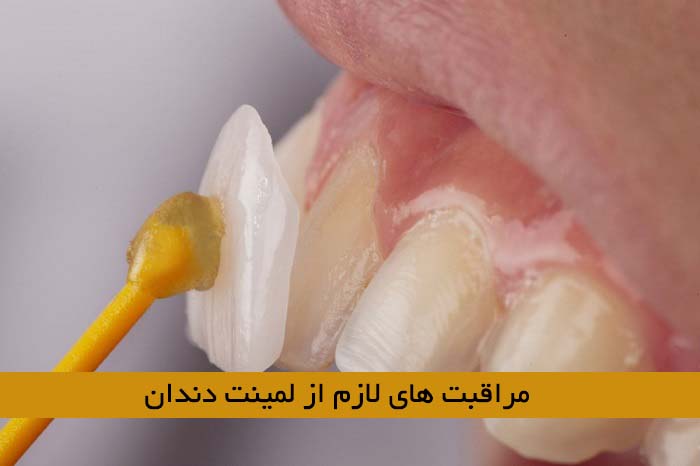 مراقبت ‌های لمینت دندان