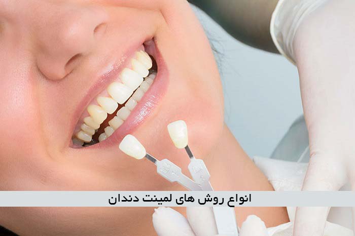 انواع روش های لمینت دندان